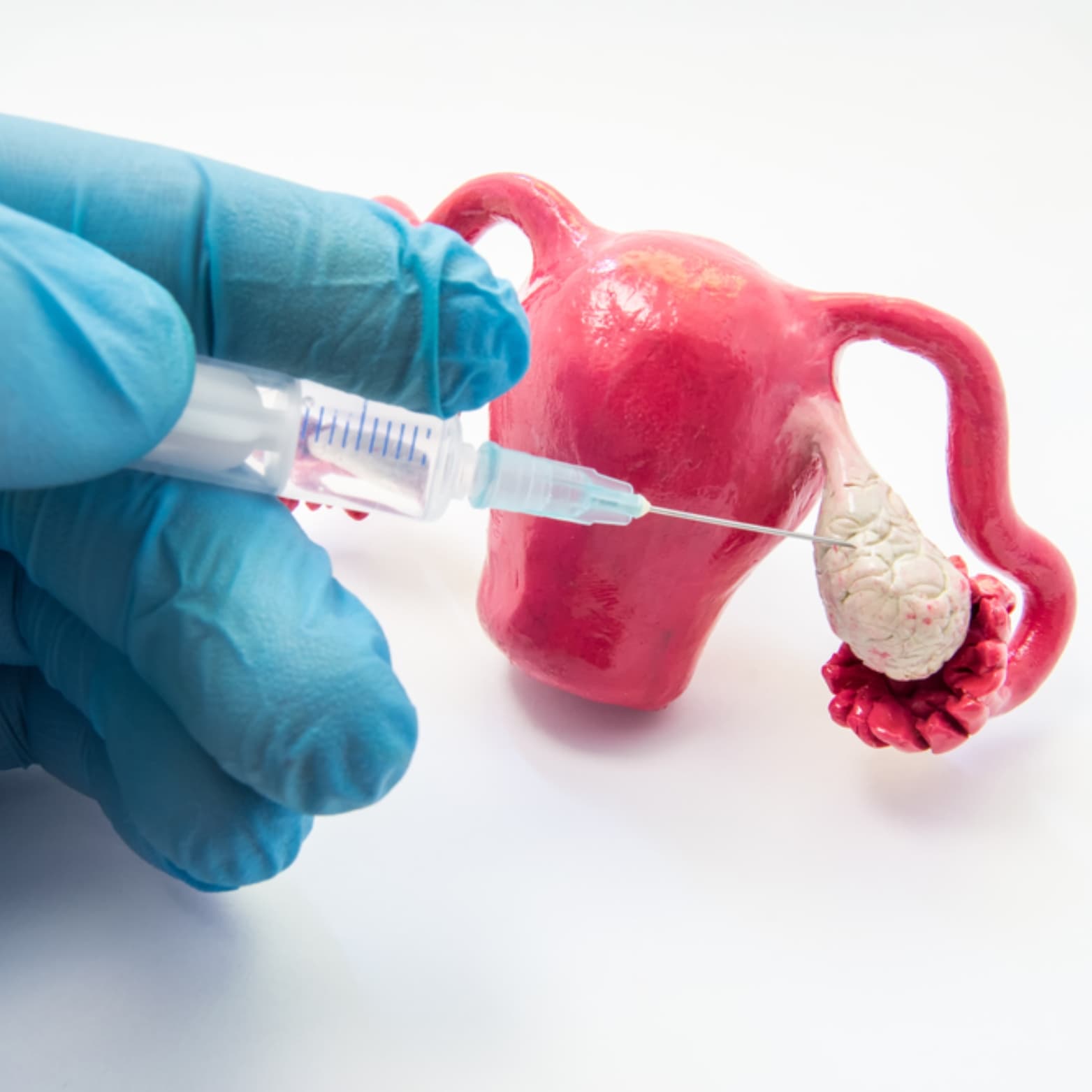 Medical illustration of IVF treatment process