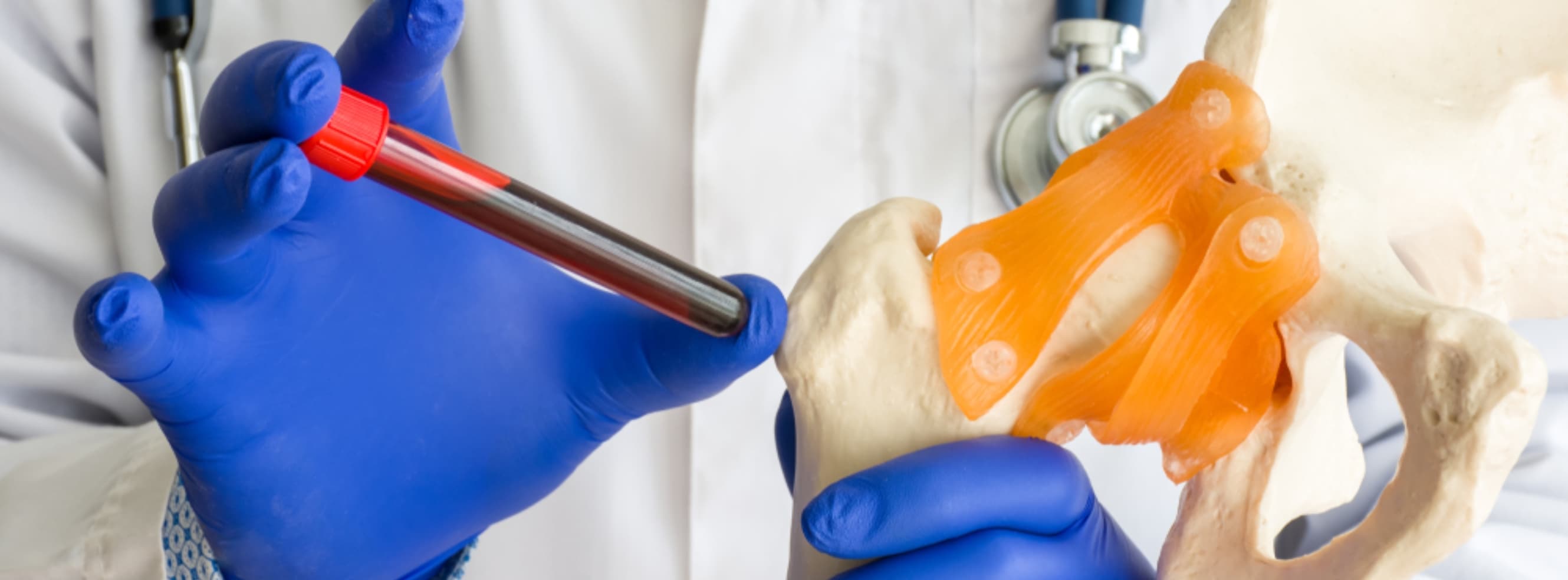 Medical illustration of bone marrow transplant procedure