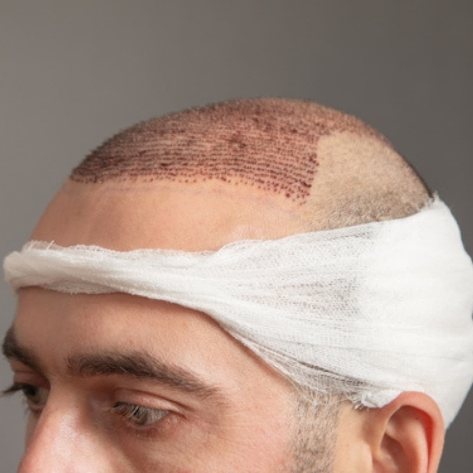 Before and after illustration of hair transplant results